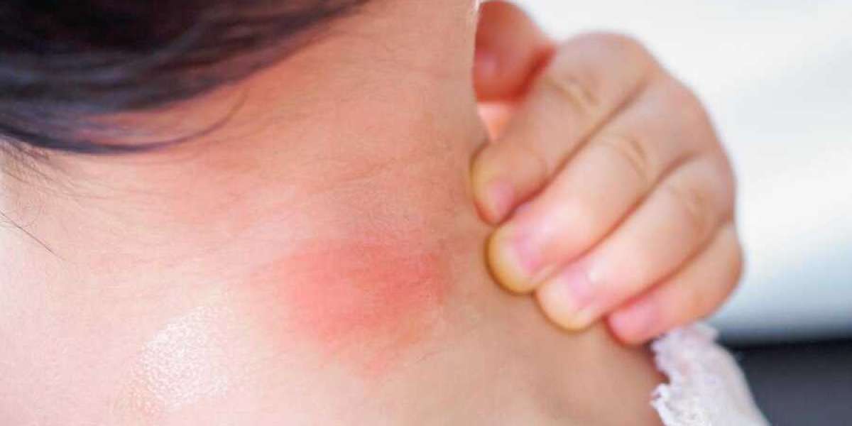 Living with Chronic Urticaria: Expert Advice from Alexandria Specialists