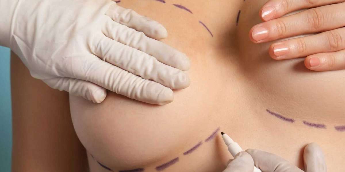 Fat Transfer for Resolving Breast Implant Complications