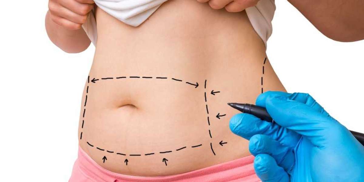 How Tummy Tuck Surgery Can Address Chronic Abdominal Issues