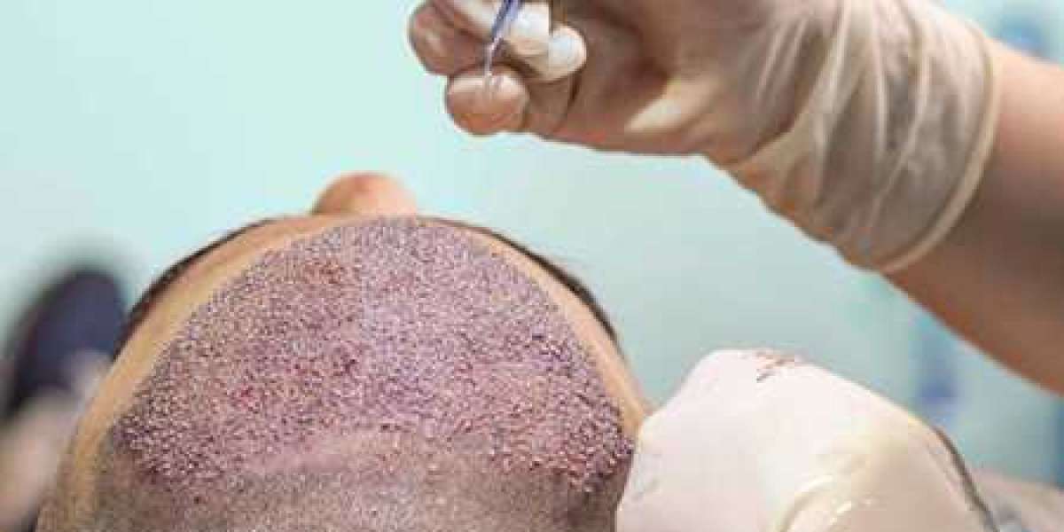 Why Choose Panacea Global Hair & Skin Services for Hair Transplant in Delhi?