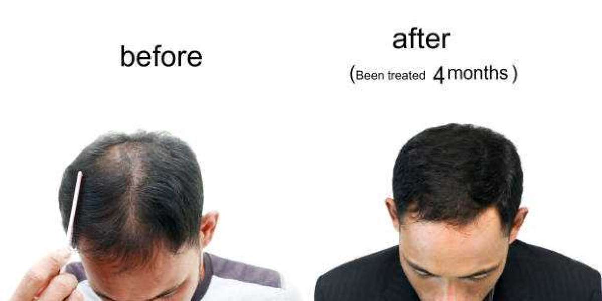 Best Hair Transplant in Karachi: Top Clinics and Expert Solutions