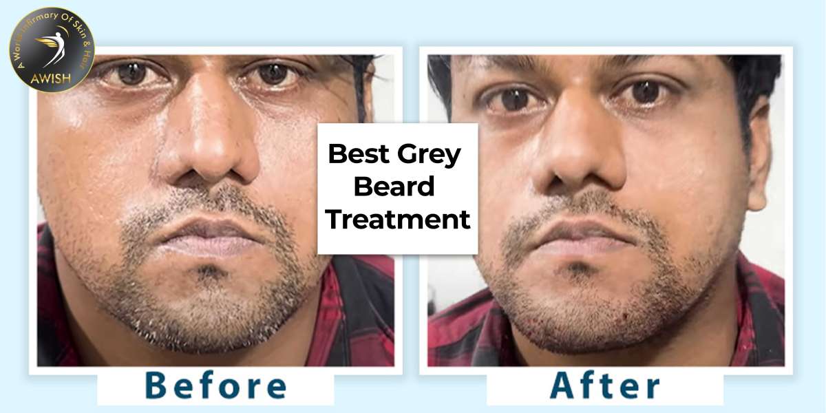 Best Clinics and Doctors for Grey Beard Treatment in Delhi ?